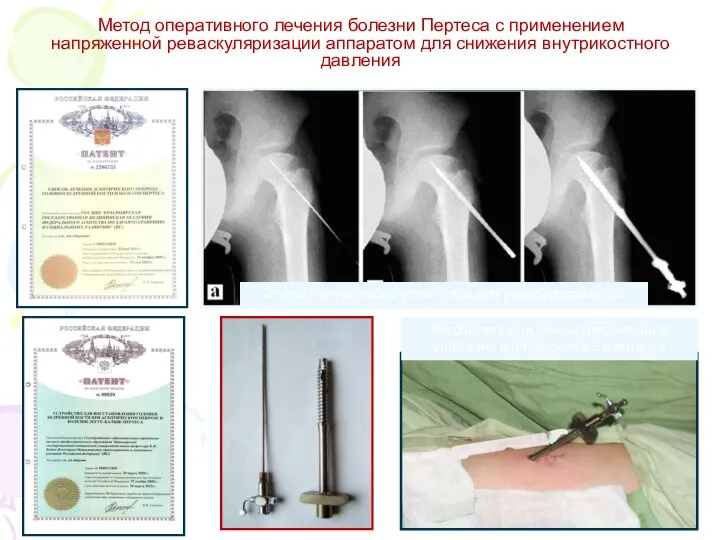 Метод оперативного лечения болезни Пертеса с применением напряженной реваскуляризации аппаратом для