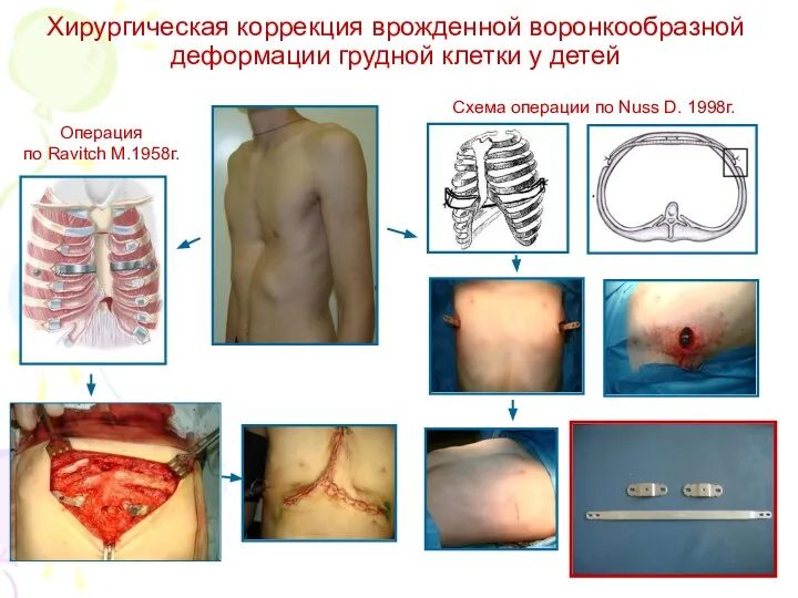 Хирургическая коррекция врожденной воронкообразной деформации грудной клетки у детей Операция по