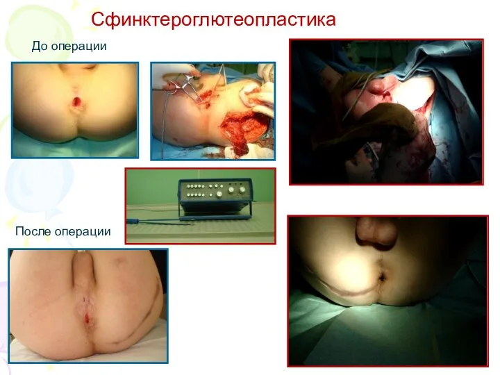 Сфинктероглютеопластика После операции До операции