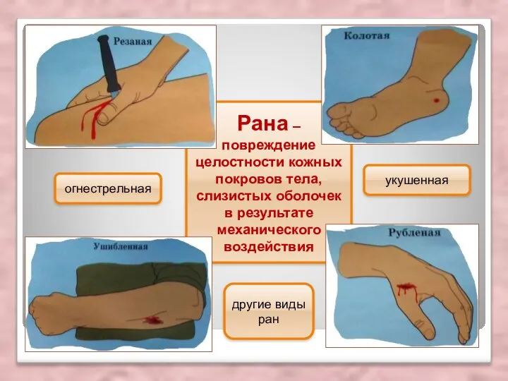 Рана – повреждение целостности кожных покровов тела, слизистых оболочек в результате