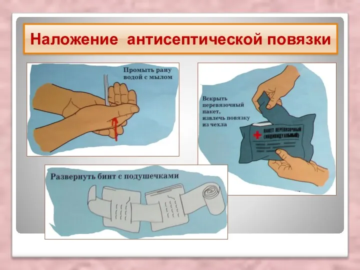 Наложение антисептической повязки