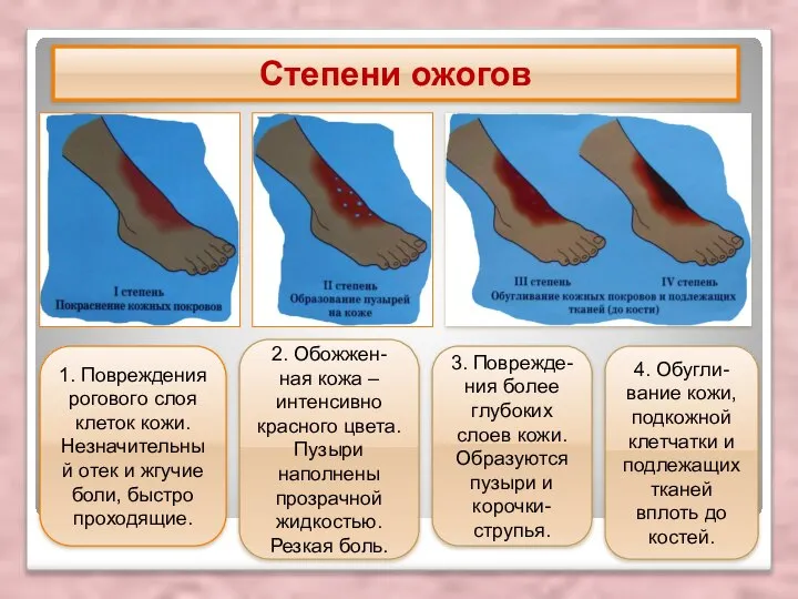 Степени ожогов 1. Повреждения рогового слоя клеток кожи. Незначительный отек и