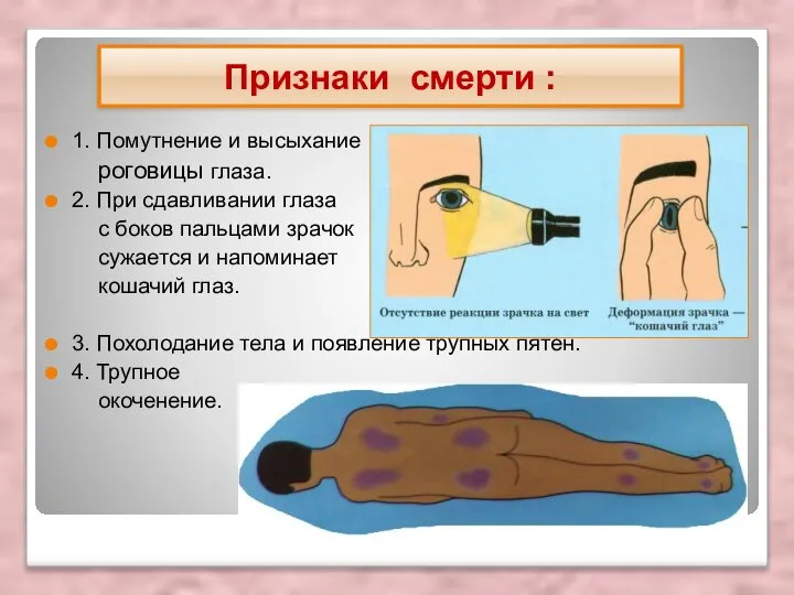 1. Помутнение и высыхание роговицы глаза. 2. При сдавливании глаза с