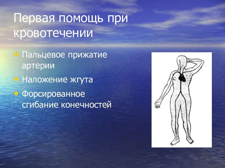 Первая помощь при кровотечении Пальцевое прижатие артерии Наложение жгута Форсированное сгибание конечностей