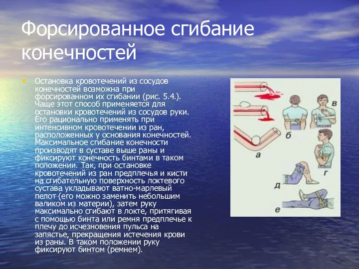 Форсированное сгибание конечностей Остановка кровотечений из сосудов конечностей возможна при форсированном