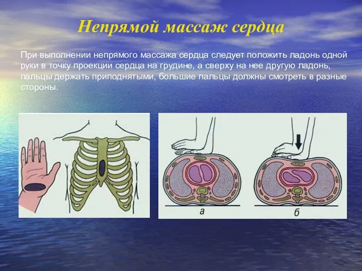 При выполнении непрямого массажа сердца следует положить ладонь одной руки в