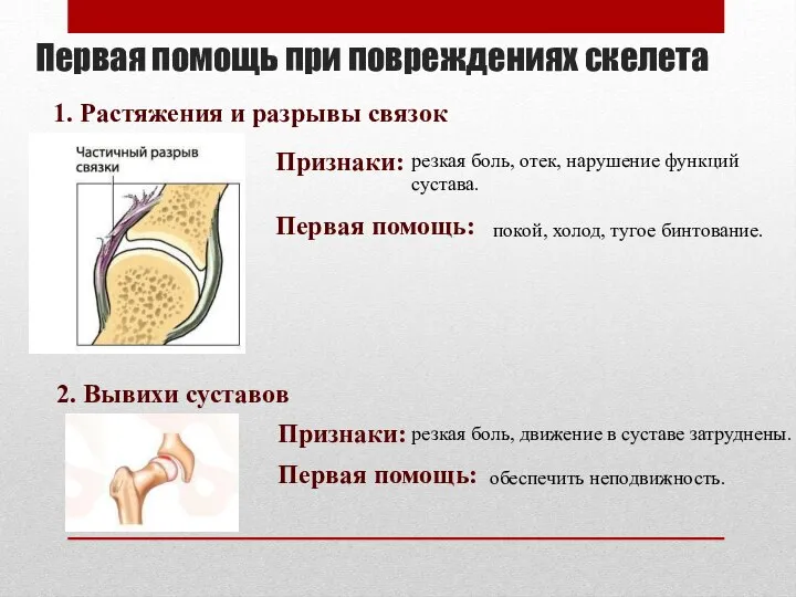 Первая помощь при повреждениях скелета 1. Растяжения и разрывы связок Признаки: