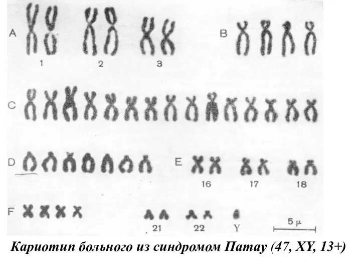 Кариотип больного из синдромом Патау (47, XY, 13+)