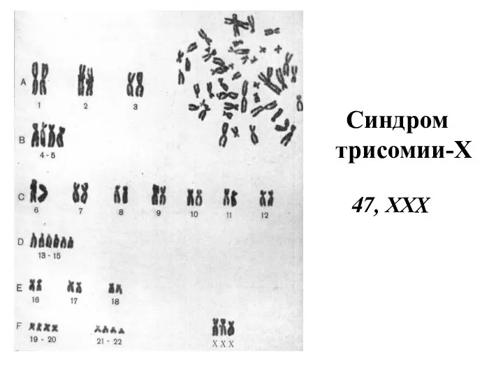 Синдром трисомии-Х 47, ХХX