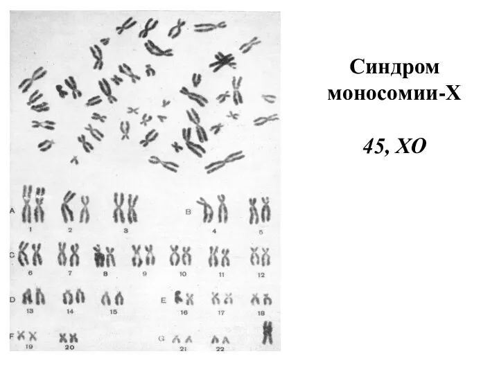 Синдром моносомии-Х 45, XO