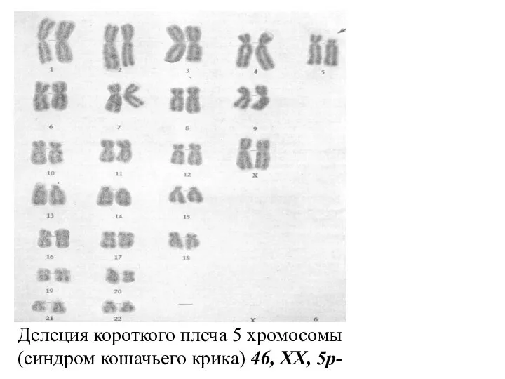 Делеция короткого плеча 5 хромосомы (синдром кошачьего крика) 46, XX, 5p-