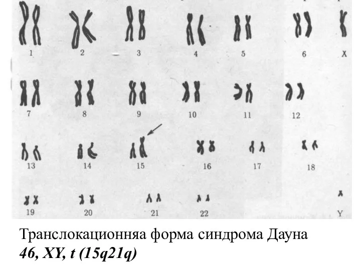 Транслокационняа форма синдрома Дауна 46, XY, t (15q21q)