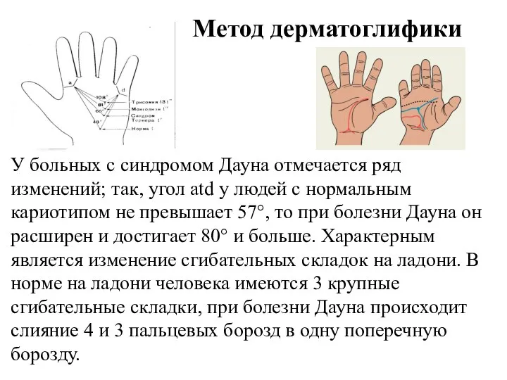 Метод дерматоглифики У больных с синдромом Дауна отмечается ряд изменений; так,