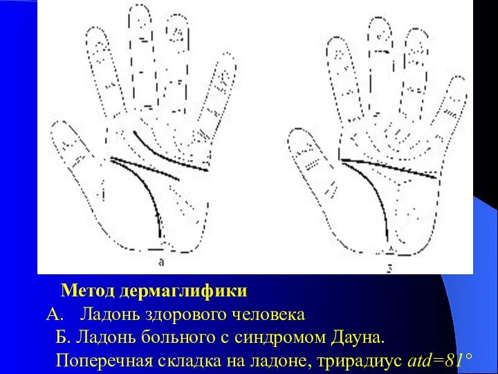 Метод дермаглифики Ладонь здорового человека Б. Ладонь больного с синдромом Дауна.