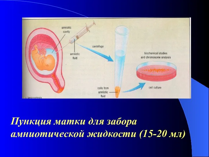 Пункция матки для забора амниотической жидкости (15-20 мл)