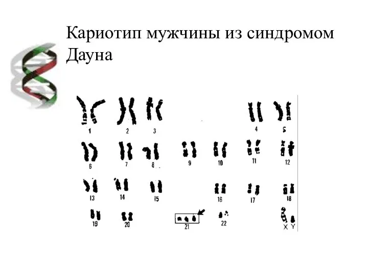 Кариотип мужчины из синдромом Дауна