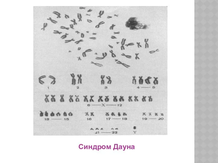 Синдром Дауна