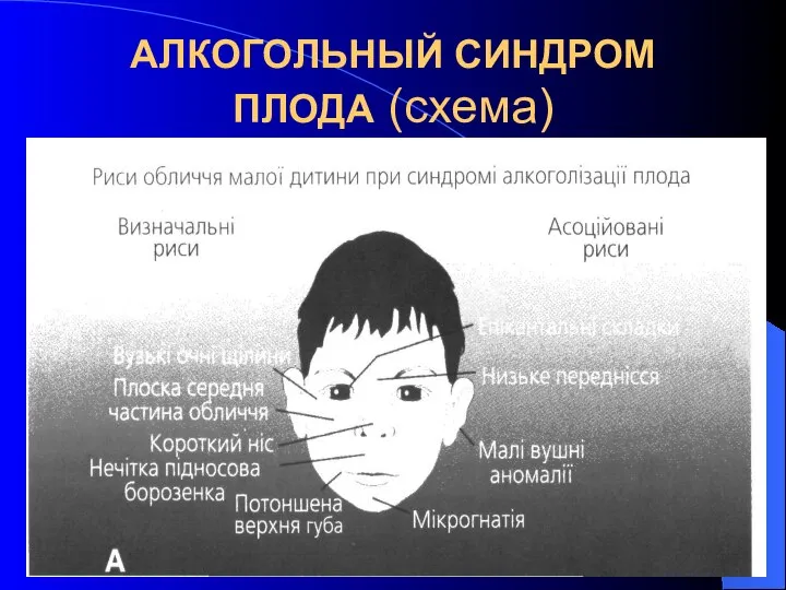 АЛКОГОЛЬНЫЙ СИНДРОМ ПЛОДА (схема)