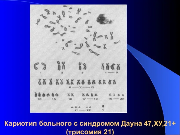 Кариотип больного с синдромом Дауна 47,ХУ,21+ (трисомия 21)