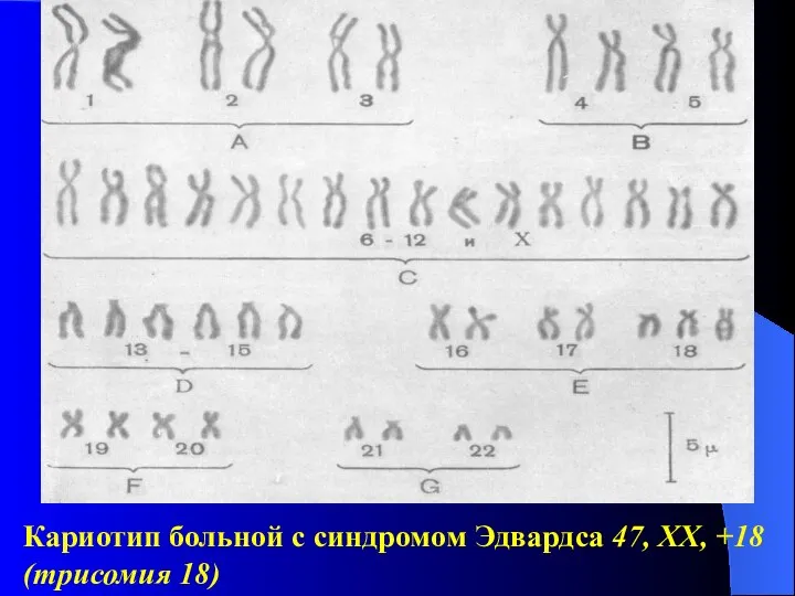 Кариотип больной с синдромом Эдвардса 47, XX, +18 (трисомия 18)