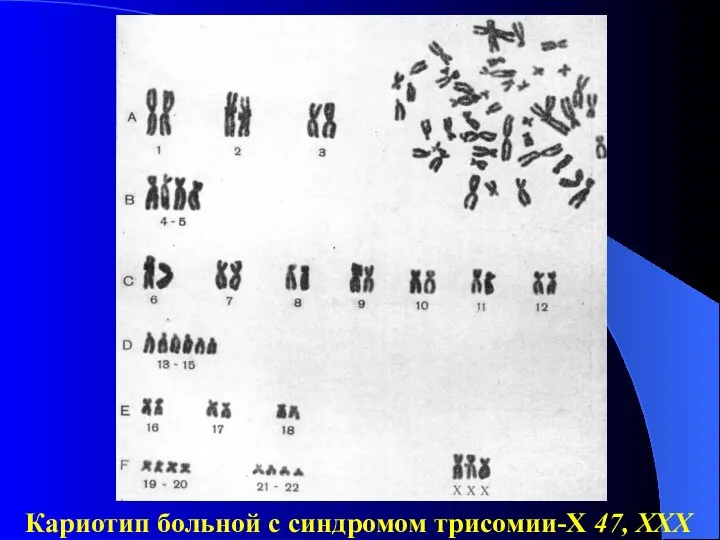 Кариотип больной с синдромом трисомии-Х 47, XXX