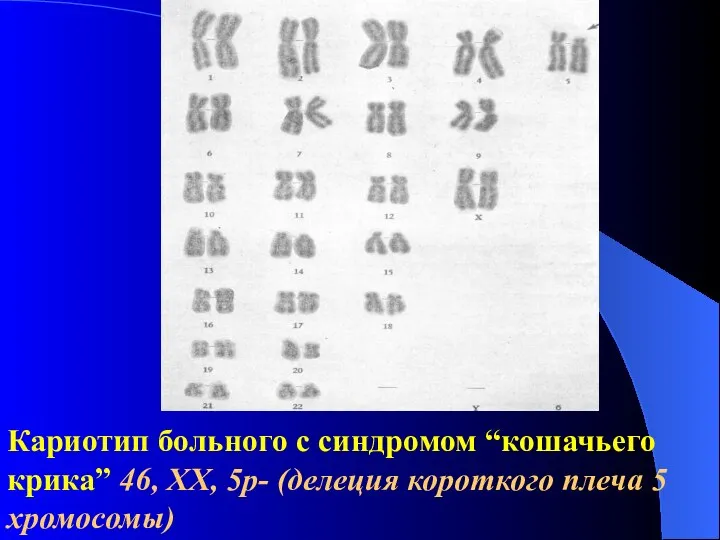 Кариотип больного с синдромом “кошачьего крика” 46, XX, 5p- (делеция короткого плеча 5 хромосомы)