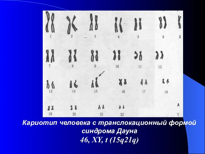 Кариотип человека с транслокационный формой синдрома Дауна 46, XY, t (15q21q)