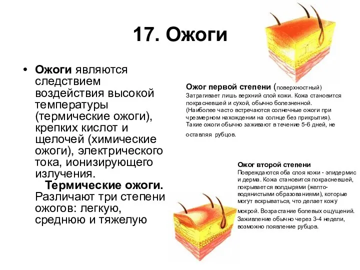 17. Ожоги Ожоги являются следствием воздействия высокой температуры (термические ожоги), крепких