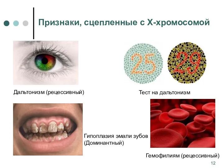 Признаки, сцепленные с Х-хромосомой Дальтонизм (рецессивный) Гемофилиям (рецессивный) Гипоплазия эмали зубов (Доминантный)