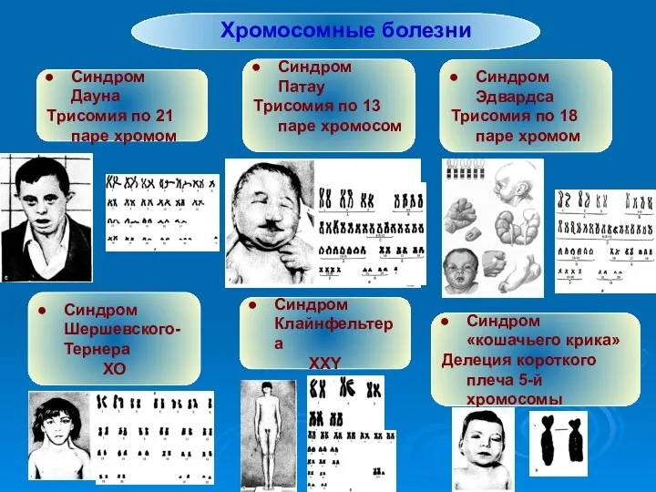 Хромосомные болезни Синдром Дауна Трисомия по 21 паре хромом Синдром Патау