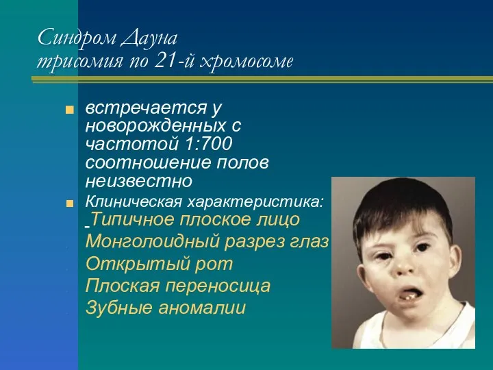 Синдром Дауна трисомия по 21-й хромосоме встречается у новорожденных с частотой