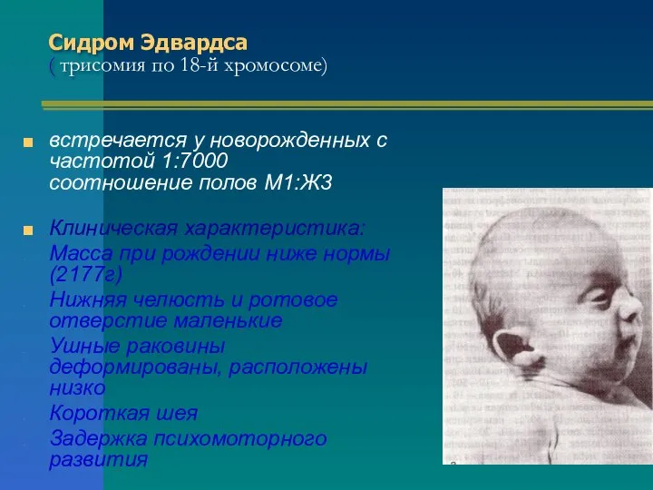 Сидром Эдвардса ( трисомия по 18-й хромосоме) встречается у новорожденных с