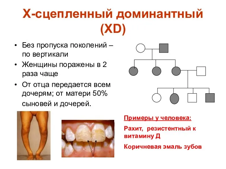 Х-сцепленный доминантный (XD) Без пропуска поколений – по вертикали Женщины поражены