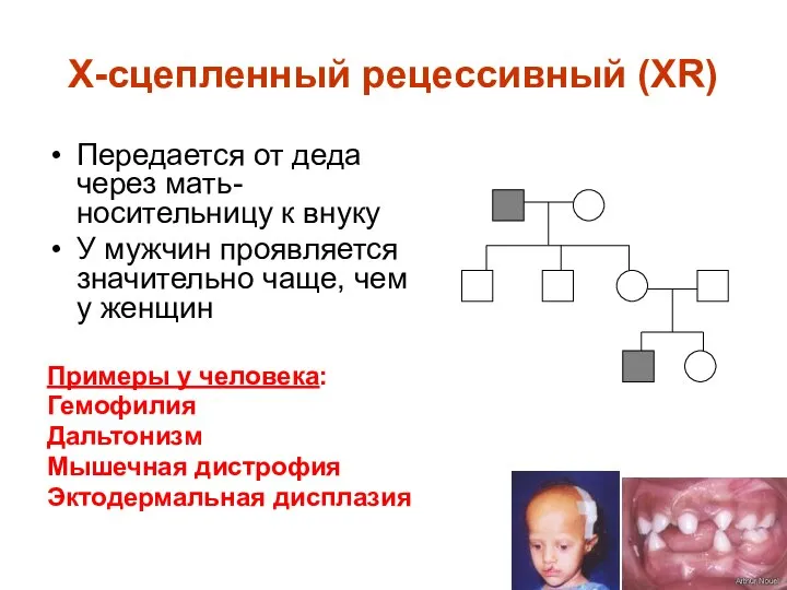 Х-сцепленный рецессивный (XR) Передается от деда через мать-носительницу к внуку У