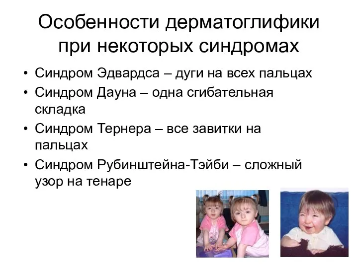 Особенности дерматоглифики при некоторых синдромах Синдром Эдвардса – дуги на всех