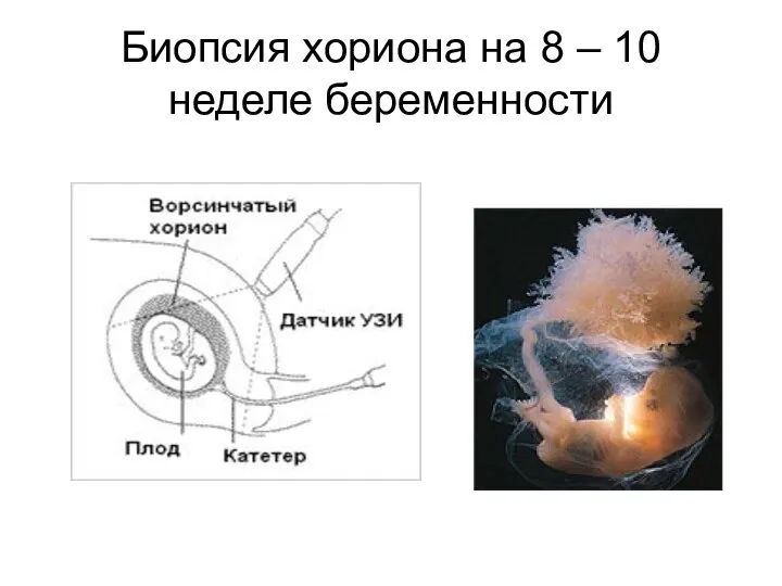 Биопсия хориона на 8 – 10 неделе беременности