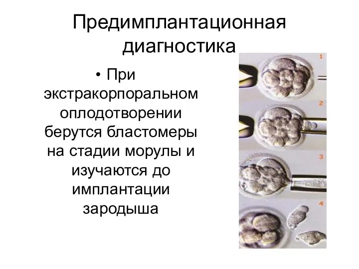 Предимплантационная диагностика При экстракорпоральном оплодотворении берутся бластомеры на стадии морулы и изучаются до имплантации зародыша