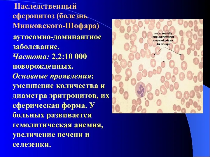 Наследственный сфероцитоз (болезнь Минковского-Шофара) аутосомно-доминантное заболевание. Частота: 2,2:10 000 новорожденных. Основные