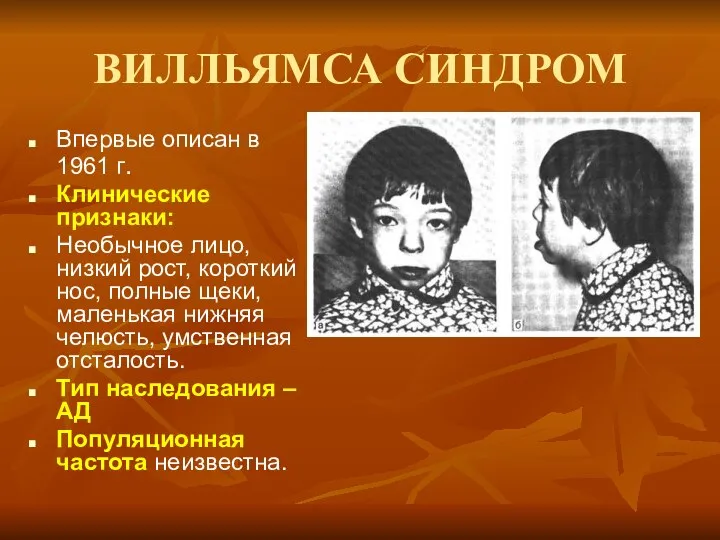 ВИЛЛЬЯМСА СИНДРОМ Впервые описан в 1961 г. Клинические признаки: Необычное лицо,