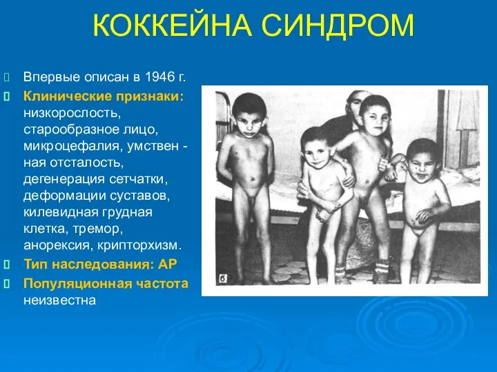 КОККЕЙНА СИНДРОМ Впервые описан в 1946 г. Клинические признаки: низкорослость, старообразное