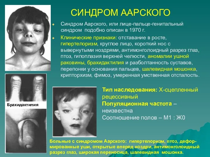 СИНДРОМ ААРСКОГО Синдром Аарского, или лице-пальце-генитальный синдром подобно описан в 1970
