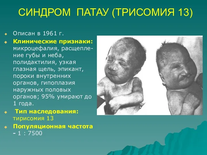 СИНДРОМ ПАТАУ (ТРИСОМИЯ 13) Описан в 1961 г. Клинические признаки: микроцефалия,