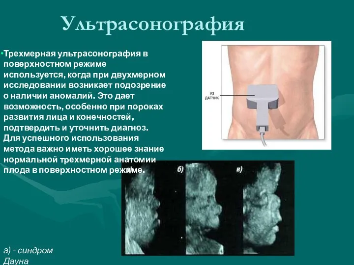 Ультрасонография a) - синдром Дауна Трехмерная ультрасонография в поверхностном режиме используется,