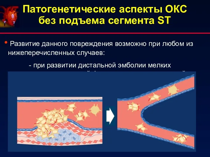 Патогенетические аспекты ОКС без подъема сегмента ST Развитие данного повреждения возможно