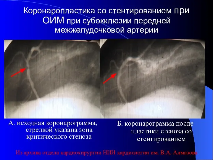 Коронаропластика со стентированием при ОИМ при субокклюзии передней межжелудочковой артерии А.