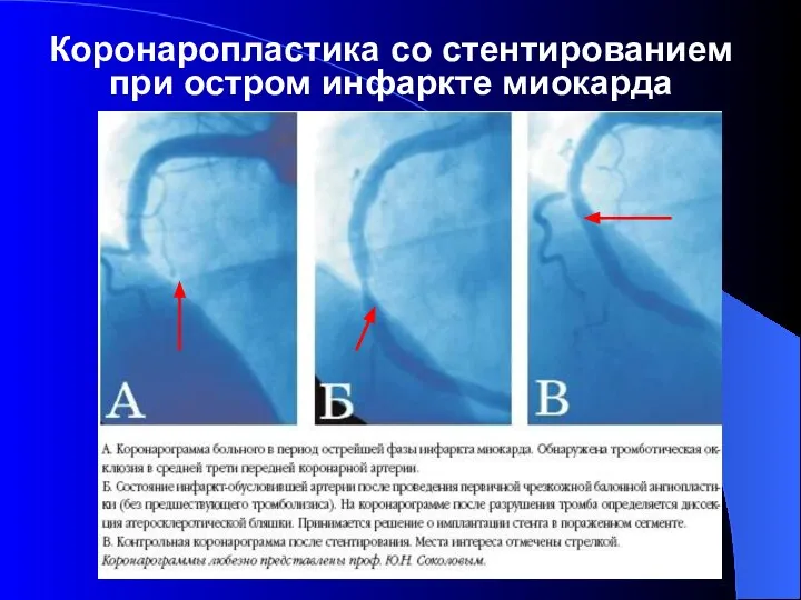 Коронаропластика со стентированием при остром инфаркте миокарда