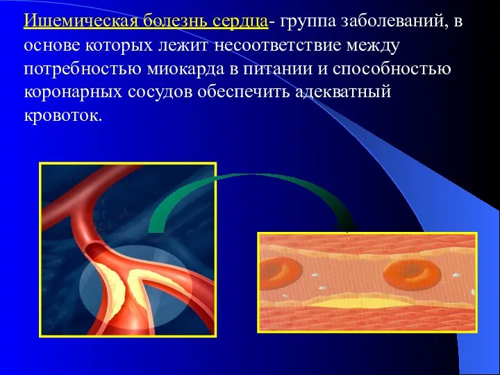 Ишемическая болезнь сердца- группа заболеваний, в основе которых лежит несоответствие между