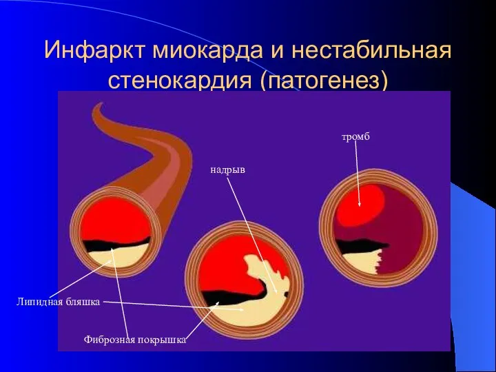 Инфаркт миокарда и нестабильная стенокардия (патогенез) Липидная бляшка Фиброзная покрышка надрыв тромб