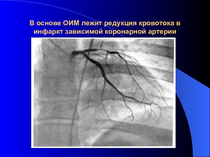 В основе ОИМ лежит редукция кровотока в инфаркт зависимой коронарной артерии