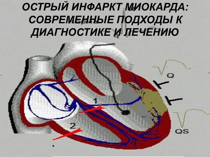 ОСТРЫЙ ИНФАРКТ МИОКАРДА: СОВРЕМЕННЫЕ ПОДХОДЫ К ДИАГНОСТИКЕ И ЛЕЧЕНИЮ